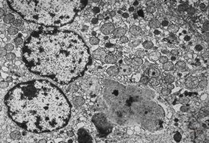 F,2m. | intracellular cholestasis - atresia of biliary ducts F,2m. | intracellular cholestasis - atresia of biliary ducts